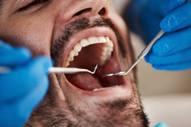 Best Knocked-Out Tooth (Avulsed Tooth) Treatment in Dexter, MO